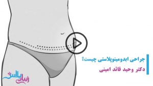 ابدومینوپلاستی,ابدومینوپلاستی بازو