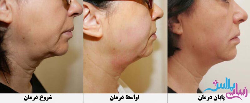 جوانسازی پوست با لیزر Co2 فرکشنال
