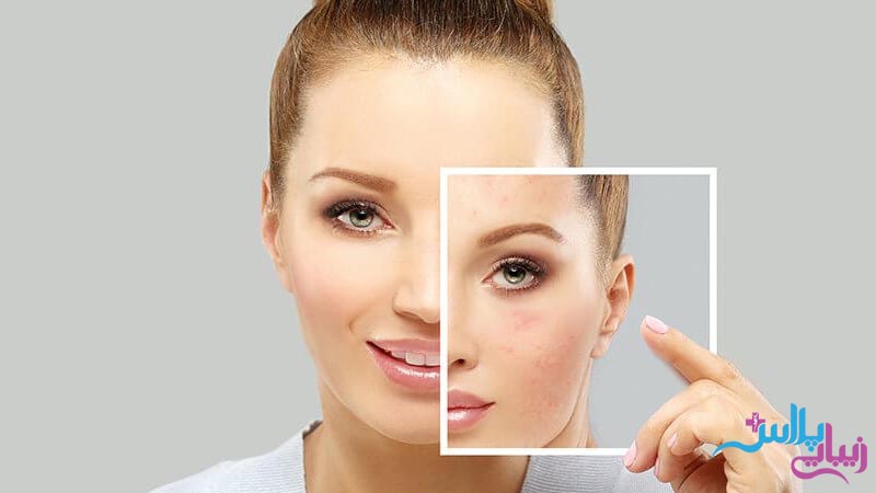 بهترین و موثرترین روش جوانسازی پوست چیست؟