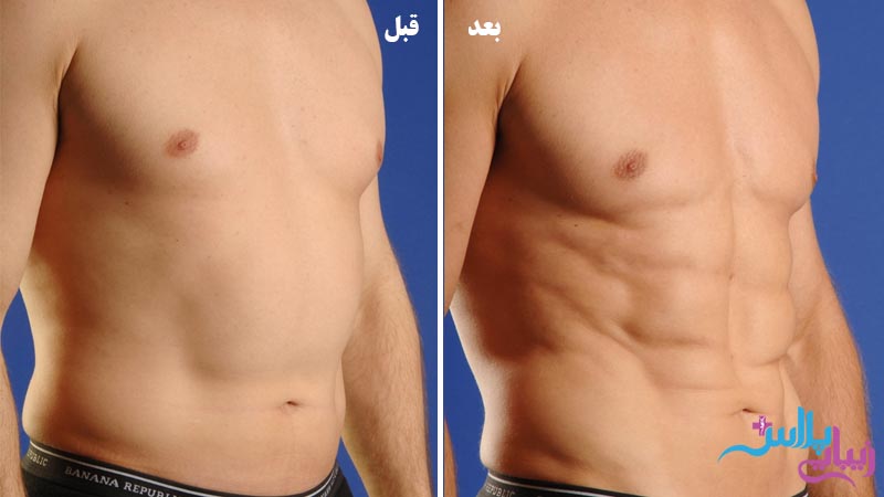 مزایا عمل لیپوساکشن