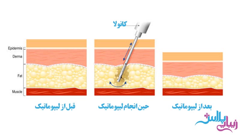 حذف چربی‌ها با لیپوساکشن