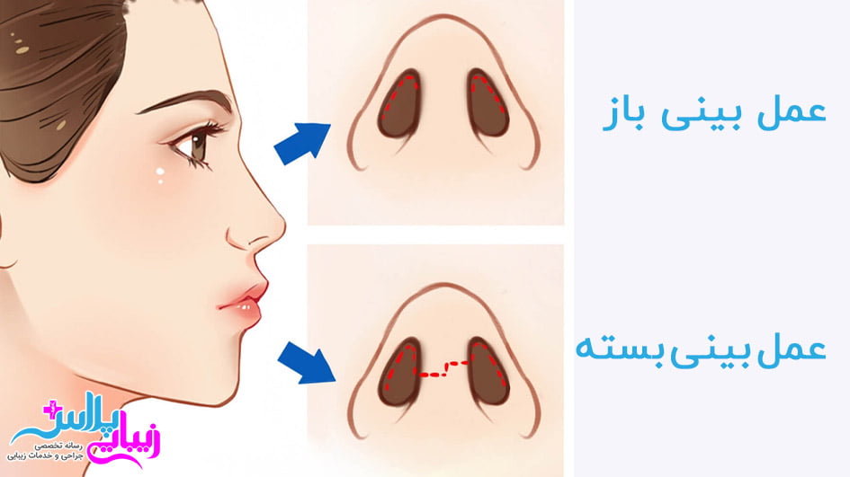 عمل بینی باز و بسته