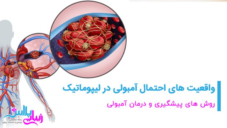 embolism lipomatic.jpg