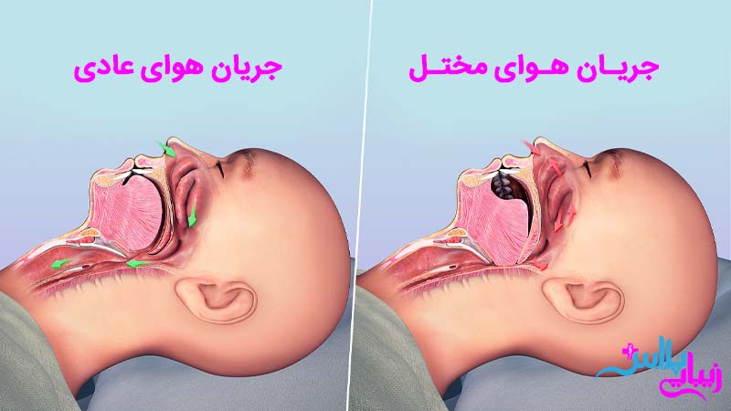 چه موقع خر و پف خطر مرگ دارد؟